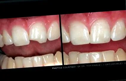 canal radicular