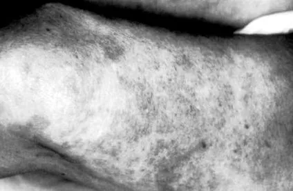 vasculitis