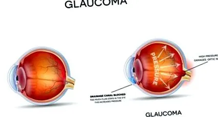 pentru glaucom