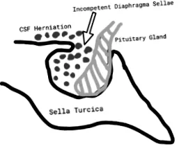 sindromul