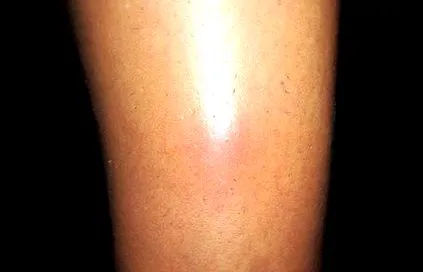 Erythema nodosum
