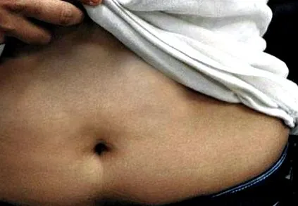 endometriózis mióma
