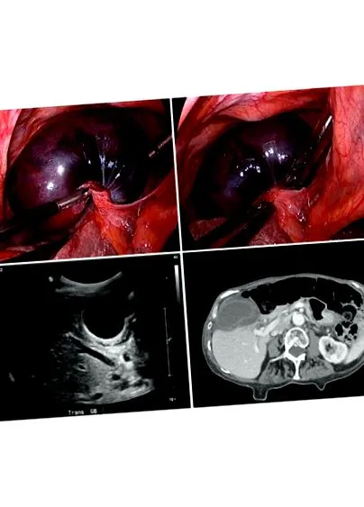 volvulus