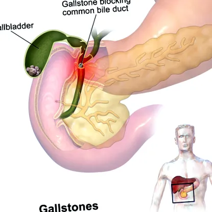gallstone