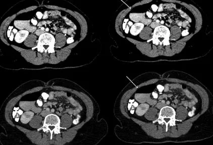 diverticul duodenal