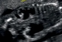 hydronephrosis