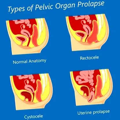 prolapsus