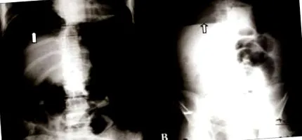 lumbricoides