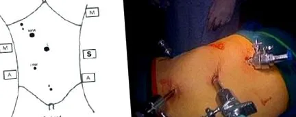 hemicolectomie