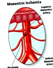 ischaemia