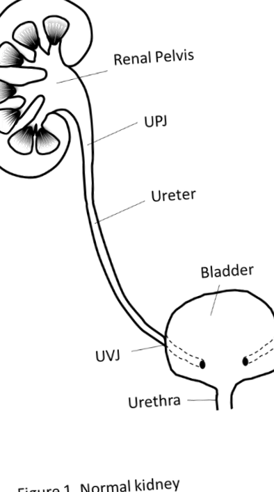 hidronefroza