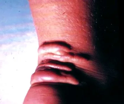 lipidanyagcsere