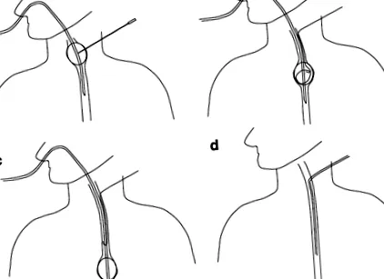 transesofagiene