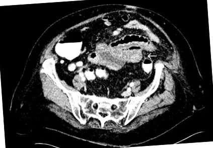 diverticulozei