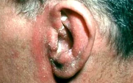 dermatita