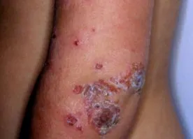 staphylococcus