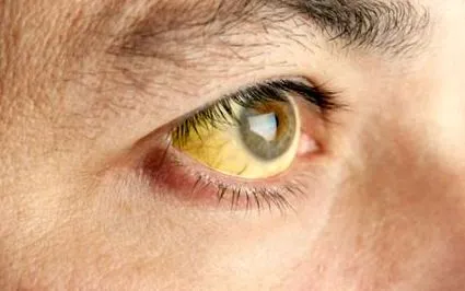 virală