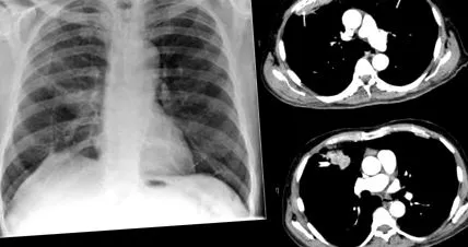 pulmonar