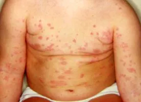 urticaria