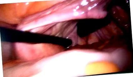 apendectomie