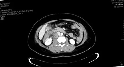angiomyolipoma
