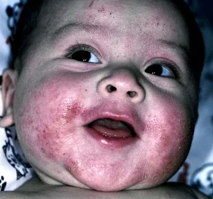 dermatitei atopice