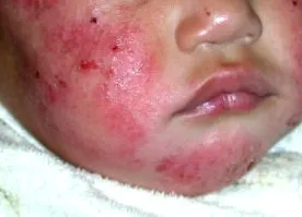 dermatitis