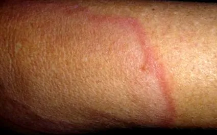 granuloma annulare
