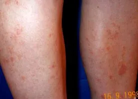 okozta capillaritis