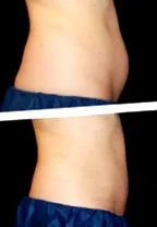 coolsculpting