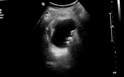 cholecystitis