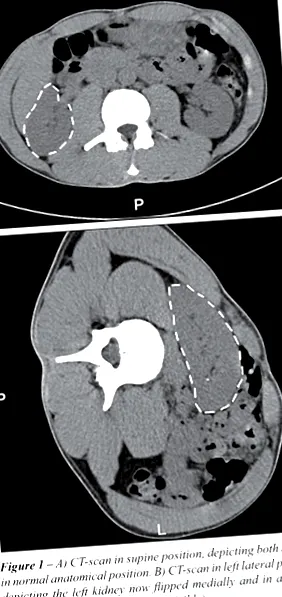 nephropexy
