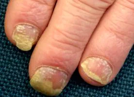 unghiilor Psoriazisul