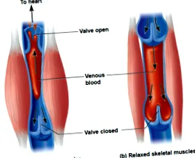 lymphedema