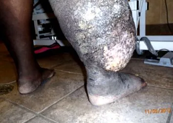lymphedema