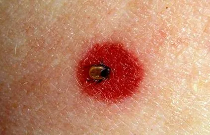 lyme