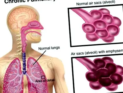 pulmonare