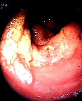 ulcer