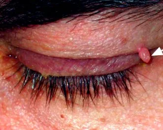 papilloma