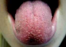 papillitis