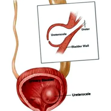 ureterocele
