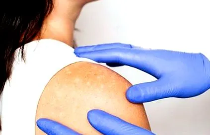 tinea