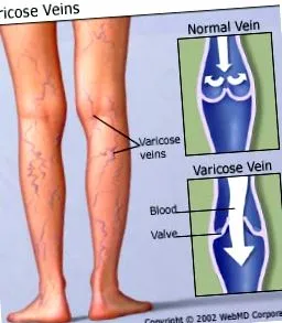 visszeres