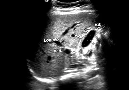 choleccistitis