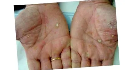 eczema