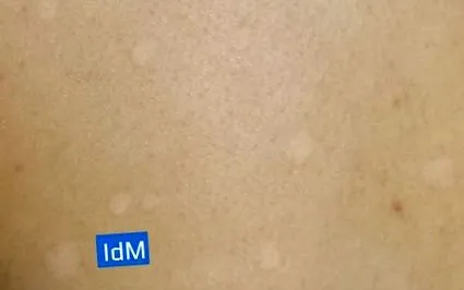pityriasis