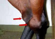 oseochondritis
