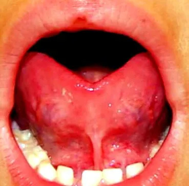 ankyloglossia