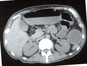 diverticulitis