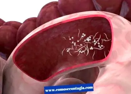 giardiasis